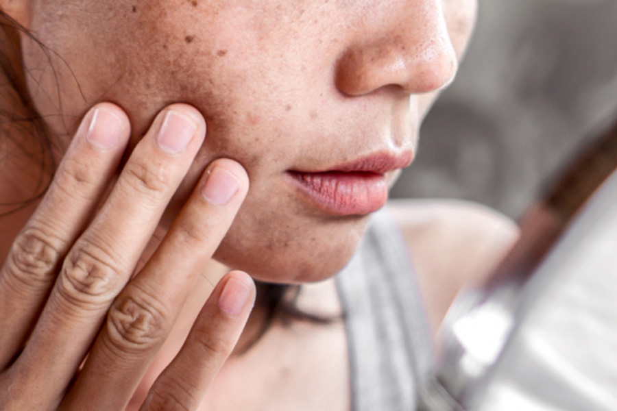 Protect Your Skin from UV Damage