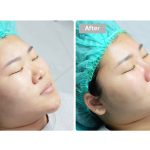 5 Simple Post Nose Surgery Tips You Must Follow