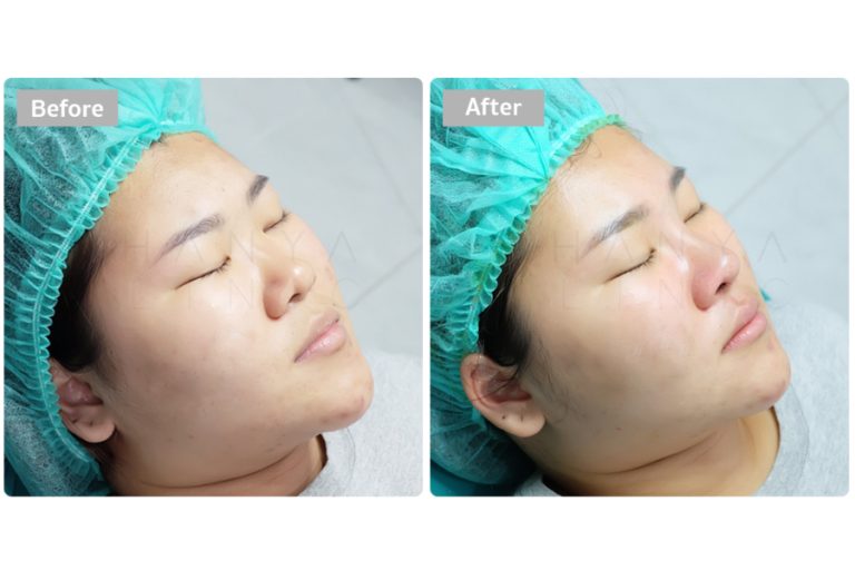 5 Simple Post Nose Surgery Tips You Must Follow