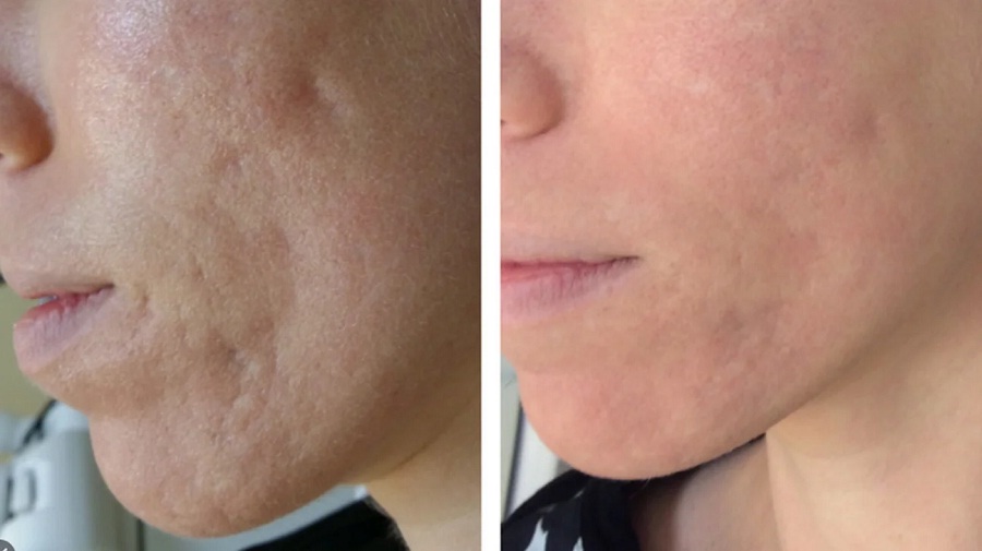 The Amazing Advantages Of Acne Scar Treatment