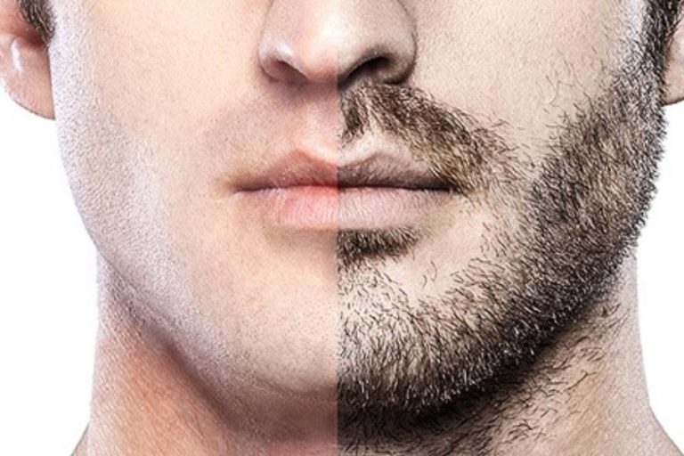 Are you on the fence about getting a beard transplant