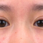 Double Eyelid Surgery Review Is It A Good Option