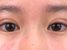 Double Eyelid Surgery Review Is It A Good Option