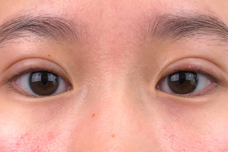 Double Eyelid Surgery Review Is It A Good Option