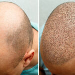 Why Should You Choose An Experienced Surgeon For Hair Transplant