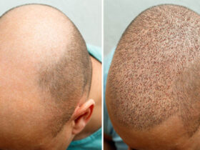 Why Should You Choose An Experienced Surgeon For Hair Transplant