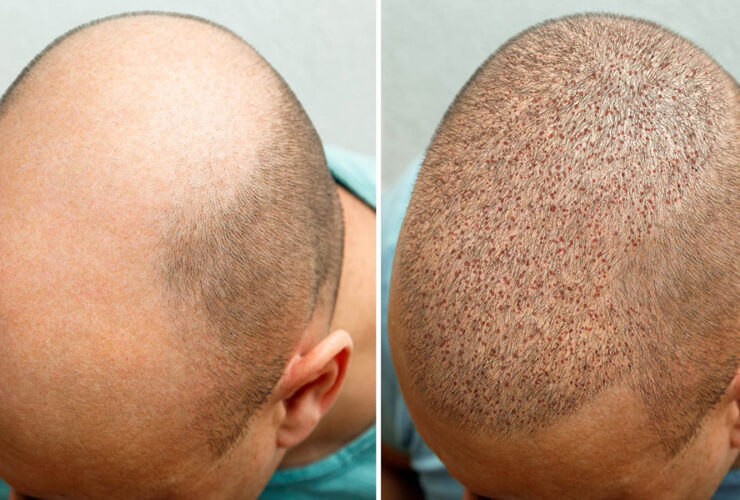 Why Should You Choose An Experienced Surgeon For Hair Transplant