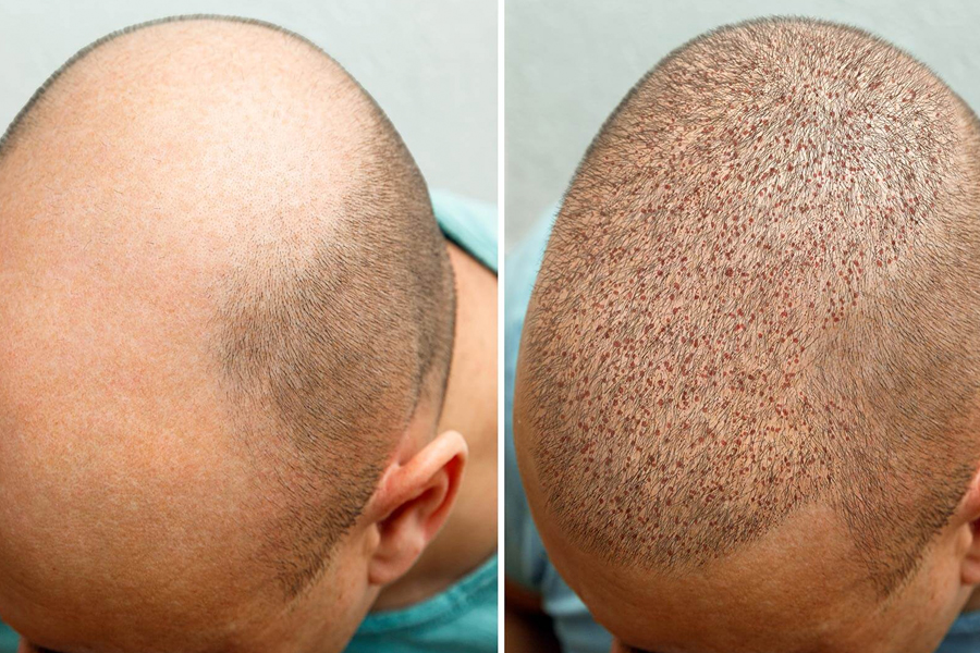 Why Should You Choose An Experienced Surgeon For Hair Transplant