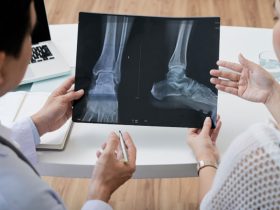 4 Myths About Knee Replacement Surgery That Delay Proper Treatment