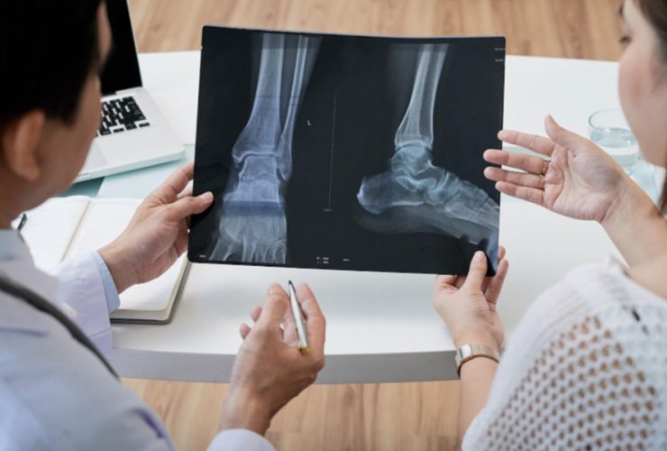 4 Myths About Knee Replacement Surgery That Delay Proper Treatment