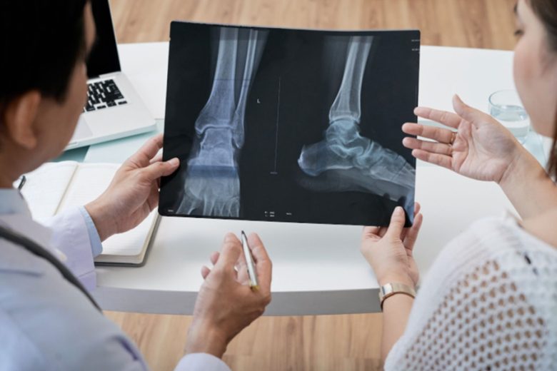 4 Myths About Knee Replacement Surgery That Delay Proper Treatment
