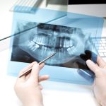 What to Expect During a Root Canal Treatment in Singapore