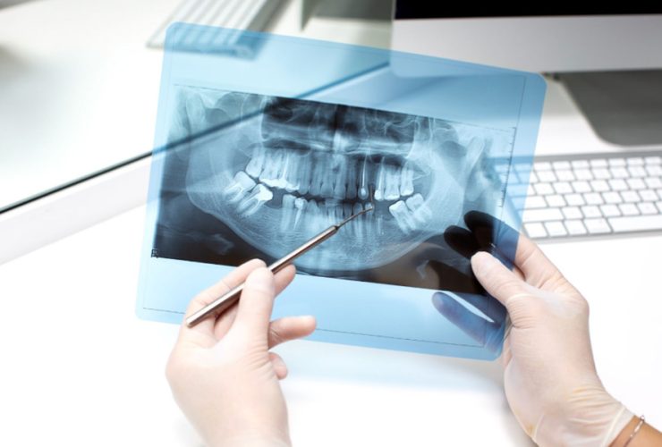 What to Expect During a Root Canal Treatment in Singapore
