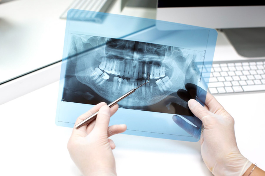 What to Expect During a Root Canal Treatment in Singapore
