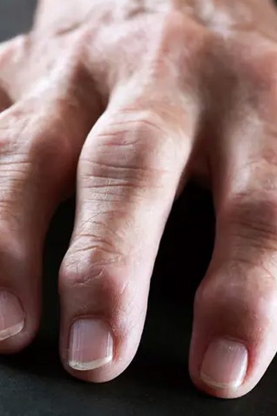 Managing Arthritis Symptoms With Advanced Regenerative Approaches