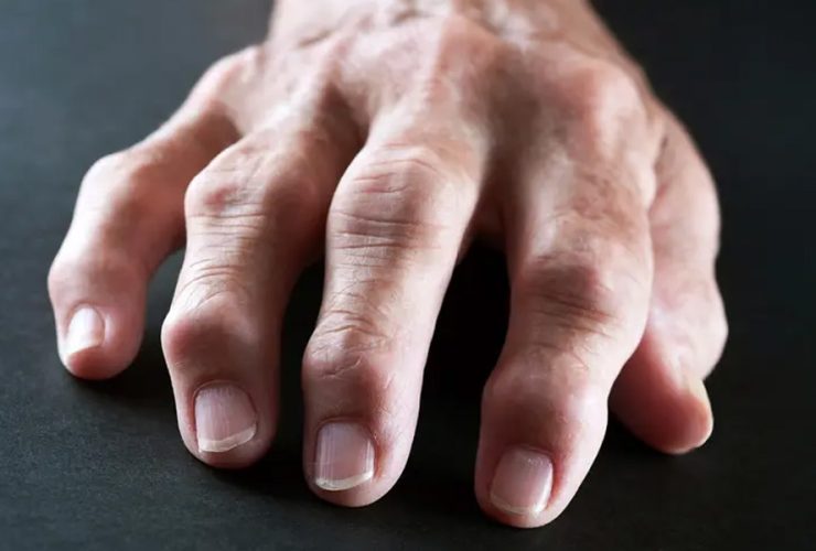 Managing Arthritis Symptoms With Advanced Regenerative Approaches