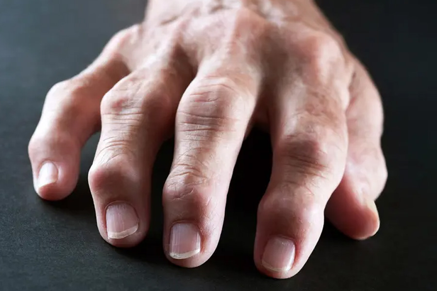 Managing Arthritis Symptoms With Advanced Regenerative Approaches